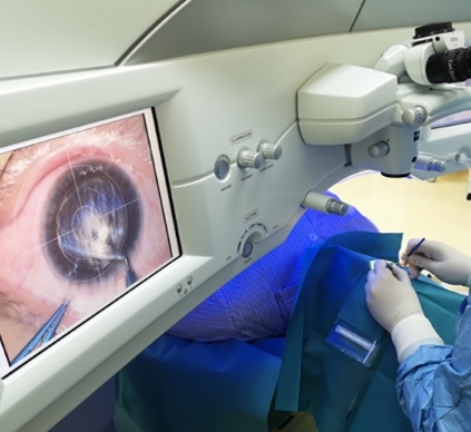 科技守護(hù)視力：探索最新全飛秒激光近視矯正技術(shù)的突破