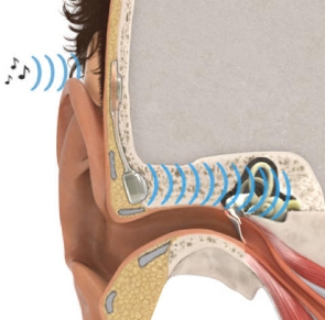 重塑聽力，聆聽夢(mèng)想：揭秘最新人工中耳植入技術(shù)的創(chuàng)新