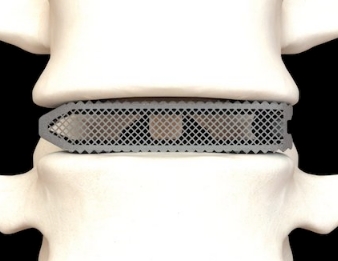 個性化脊柱治療的利器：3D打印脊柱植入物的技術進展