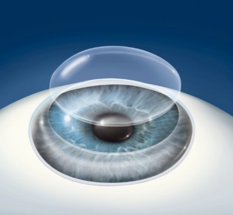 精準(zhǔn)眼科手術(shù)的未來：飛秒激光角膜移植系統(tǒng)的臨床應(yīng)用與價(jià)值