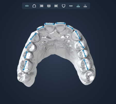 正畸分析軟件：數(shù)字化正畸規(guī)劃——正畸分析軟件的精準設計與應用
