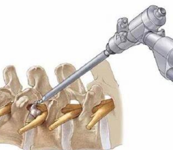 椎間盤(pán)鏡：微創(chuàng)治療椎間盤(pán)疾病——椎間盤(pán)鏡的技術(shù)進(jìn)展與操作指南