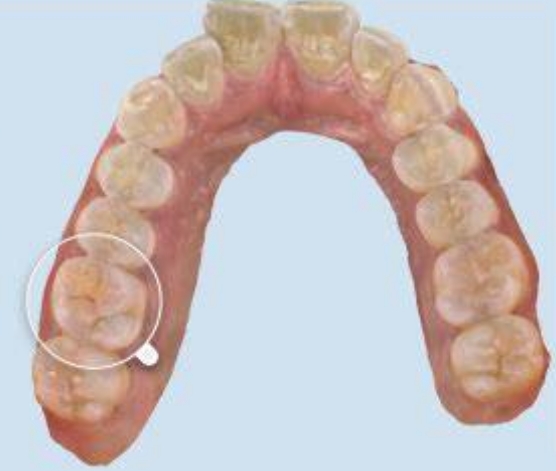 牙科數(shù)字印模系統(tǒng)