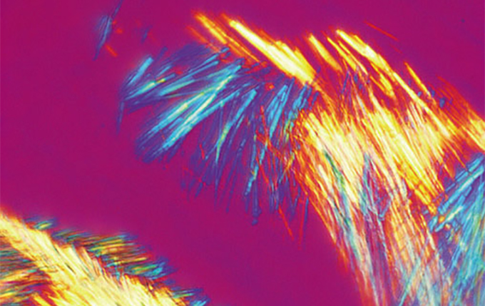 簡(jiǎn)單的痛風(fēng)檢查